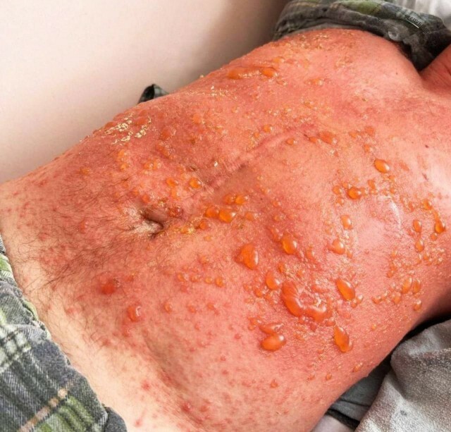 Житель Башкирии получил тяжёлые ожоги от борщевика